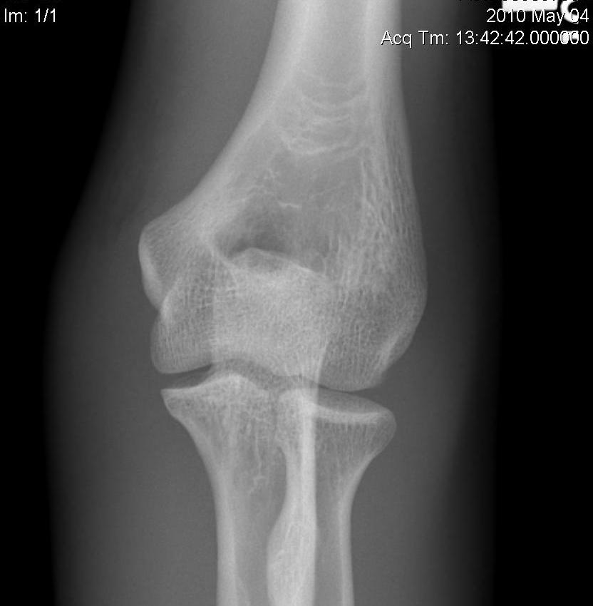 Elbow AP Normal